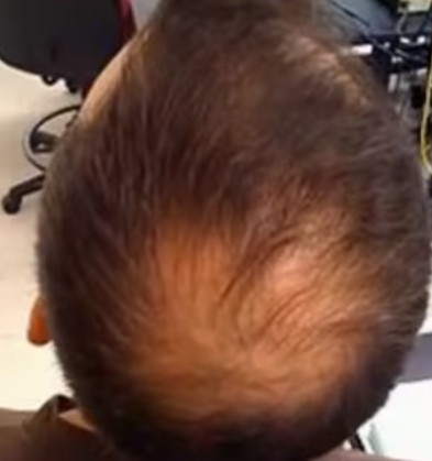 Alopecia o perdida de pelo por estres